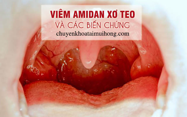 Các biến chứng nguy hiểm của viêm amidan - xơ teo