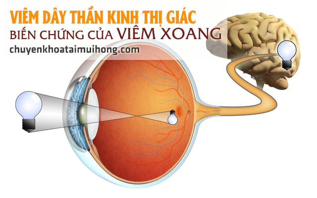 Viêm xoang khiến dây thần kinh thị giác bị viêm