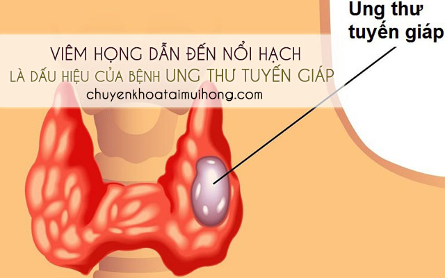 Ung thư tuyến giáp gây nên tình trạng viêm họng nổi hạch