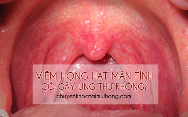 Viêm họng hạt mãn tính có gây ung thư không?