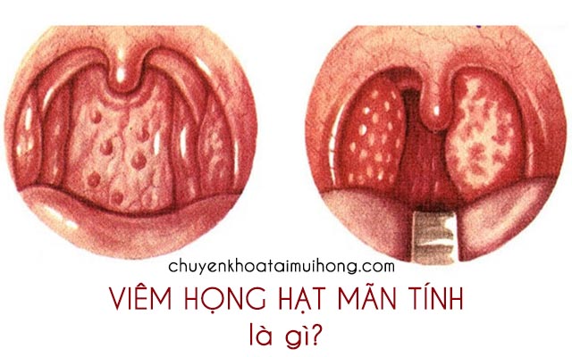 Bệnh viêm họng hạt mãn tính