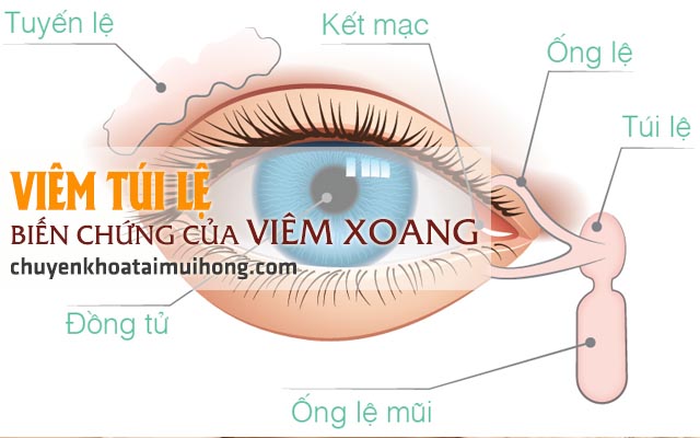 Viêm xoang gây biến chứng viêm túi lệ