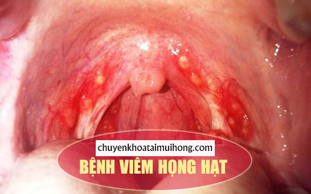 Bệnh viêm họng hạt