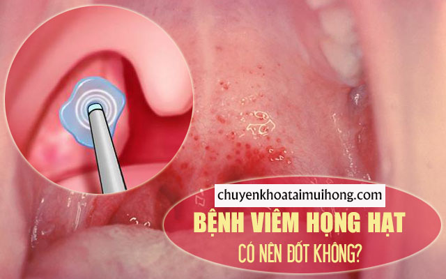 Tìm hiểubệnh viêm họng hạt có nên đốt không?