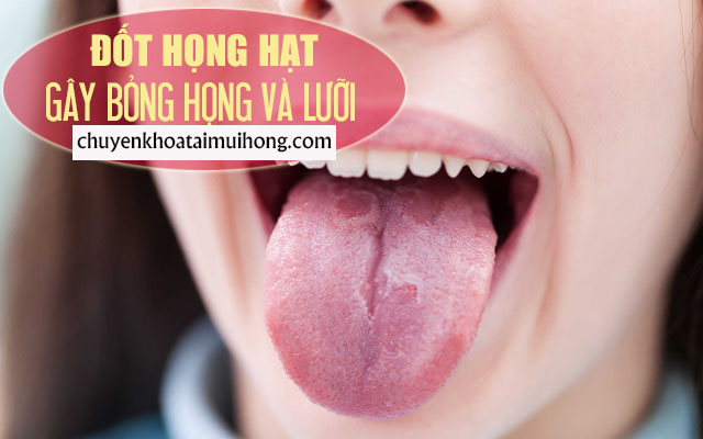 Đốt họng hạt gây bỏng vùng họng, lưỡi