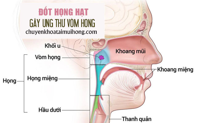 Mắc bệnh ung thư vòm họng do đốt họng hạt
