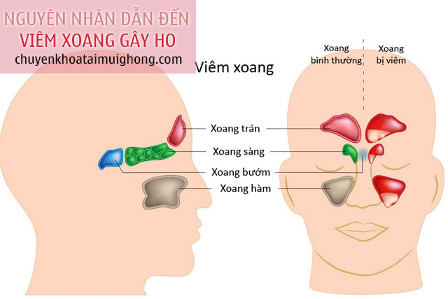 Nguyên nhân dẫn đến bệnh viêm xoang gây ho