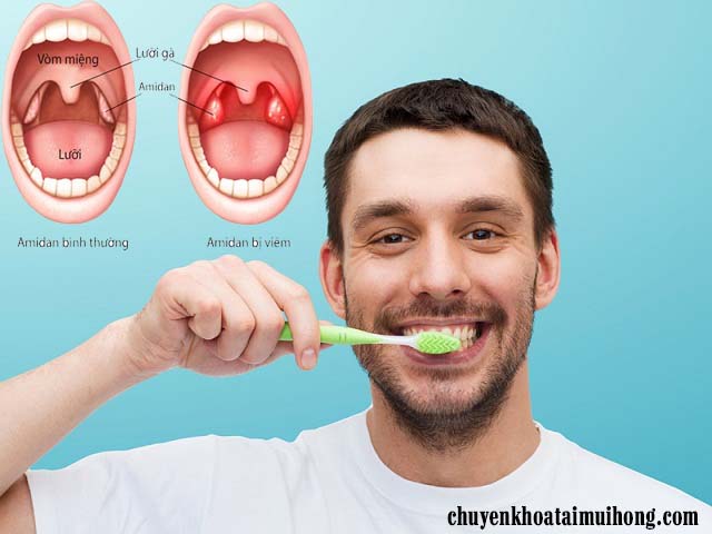 Cách vệ sinh răng miệng sau khi cắt amidan