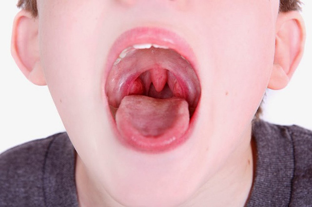 Viêm họng hạt là căn bệnh không thể tự khỏi mà cần áp dụng các biện pháp chữa trị phù hợp