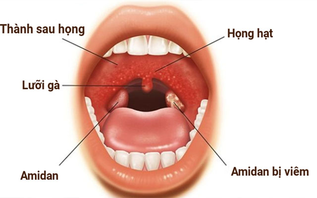 Viêm họng hạt mãn tính