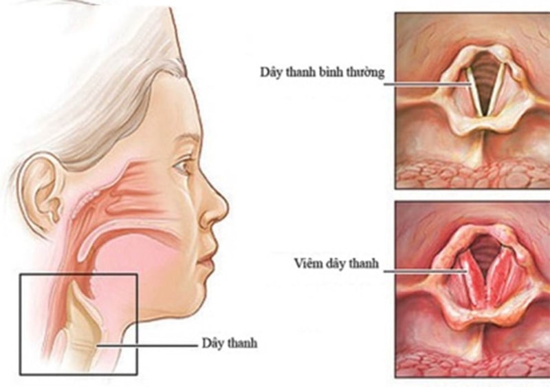 Viêm thanh quản là một trong những bệnh lý về đường hô hấp phổ biến và nguy hiểm Viêm thanh quản là một trong những bệnh lý về đường hô hấp phổ biến và nguy hiểm