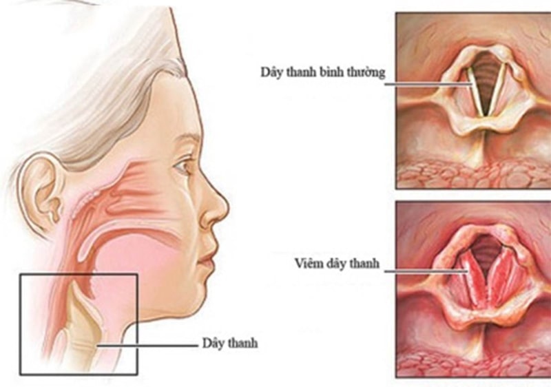 Viêm thanh quản là một trong những bệnh lý về đường hô hấp phổ biến và nguy hiểm