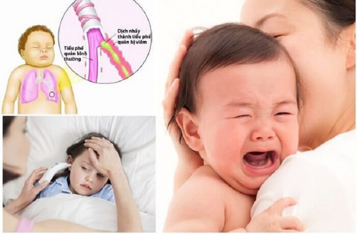 Trẻ bị viêm phế quản có biểu hiện ho, sốt liên tục, cổ họng đau rát Trẻ bị viêm phế quản có biểu hiện ho, sốt liên tục, cổ họng đau rát