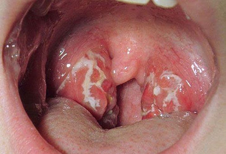 Viêm họng hạt có thể gây ung thư vòm họng nếu không điều trị kịp thời