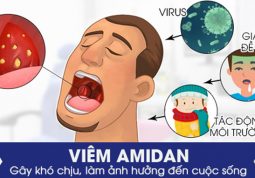 Bệnh viêm amidan cần được điều trị càng sớm càng tốt