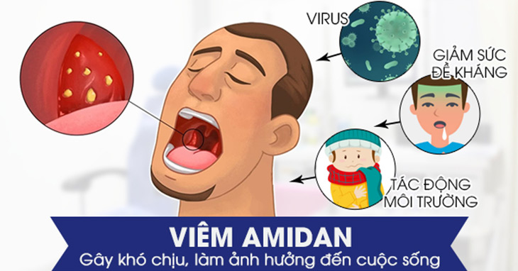 Bệnh viêm amidan cần được loại bỏ càng sớm càng tốt