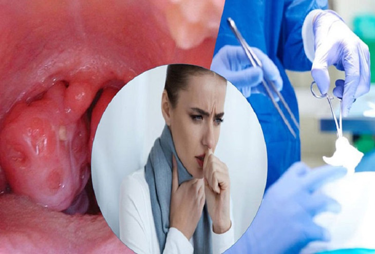 Phương pháp cắt amidan hiện nay hạn chế tối đa những biến chứng có thể gặp Phương pháp cắt amidan hiện nay hạn chế tối đa những biến chứng có thể gặp
