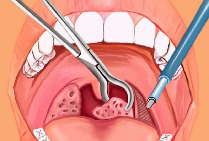 Có nên cắt amidan cho trẻ không? Vấn đề này sẽ được bác sĩ tư vấn cụ thể sau khi thăm khám Có nên cắt amidan cho trẻ không? Vấn đề này sẽ được bác sĩ tư vấn cụ thể sau khi thăm khám