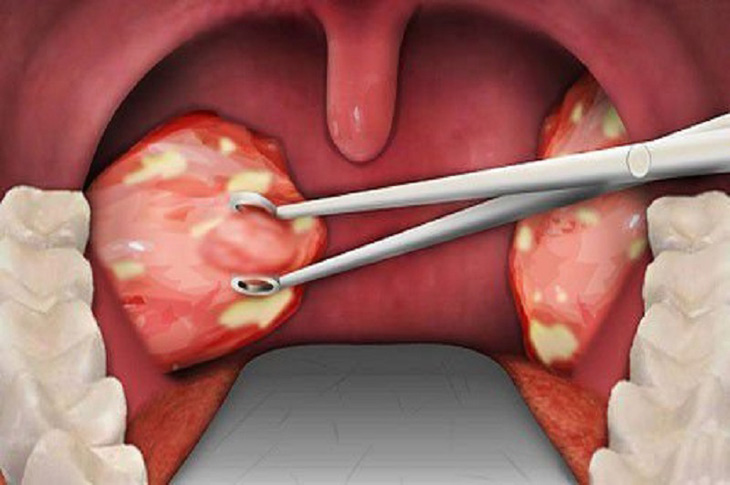 Việc có nên cắt amidan hay không sẽ do bác sĩ chỉ định dựa trên tình trạng bệnh Việc có nên cắt amidan hay không sẽ do bác sĩ chỉ định dựa trên tình trạng bệnh