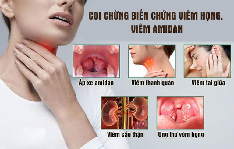 Đây là một số biến chứng của bệnh viêm amidan mà tôi đọc được trên mạng