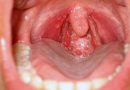 Hình ảnh viêm họng hạt