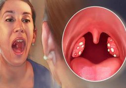 Viêm amidan có lây không là thắc mắc của nhiều người
