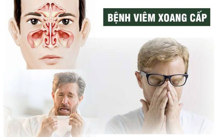 Viêm xoang cấp là tình trạng bệnh hô hấp thường gặp