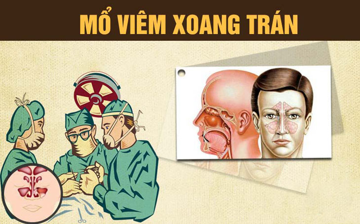 Có nên mổ viêm xoang trán không