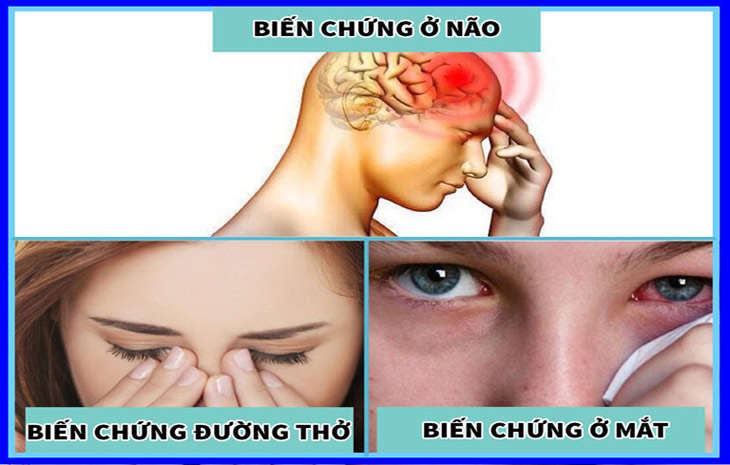 Viêm đa xoang gây nhức đầu nếu không được điều trị tốt sẽ gây nhiều biến chứng nguy hiểm