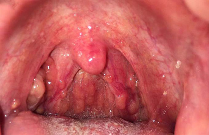 Viêm họng hạt mãn tính có thể gây ra nhiều biến chứng nguy hiểm Viêm họng hạt mãn tính có thể gây ra nhiều biến chứng nguy hiểm
