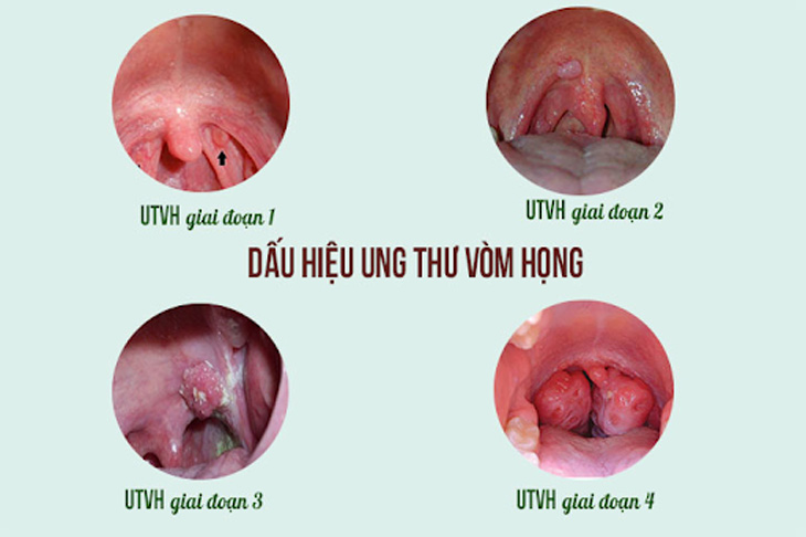 Viêm họng mãn tính có thể gây ung thư vòm họng nếu không được chữa trị