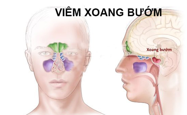 Viêm xoang bướm là tình trạng viêm niêm mạc lót trong của xoang bướm