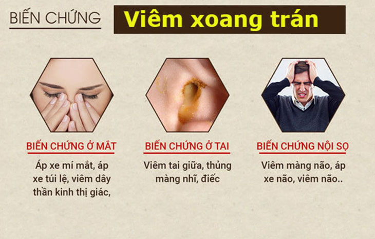 Viêm xoang trán có thể gây nhiều biến chứng nguy hiểm