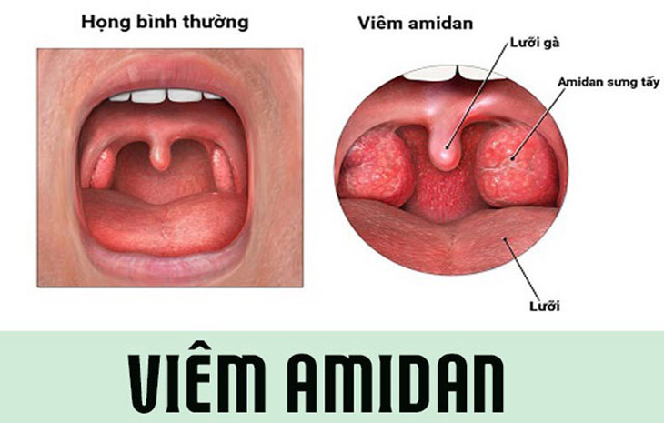 Viêm amidan cấp là tình trạng niêm mạc amidan bị viêm nhiễm