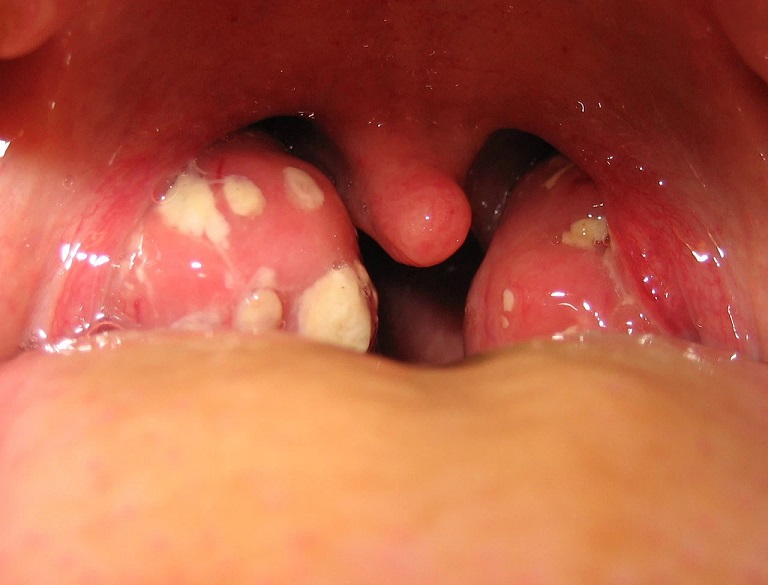 Bệnh viêm amidan hốc mủ là giai đoạn chuyển biến nặng của bệnh amidan Bệnh viêm amidan hốc mủ là giai đoạn chuyển biến nặng của bệnh amidan