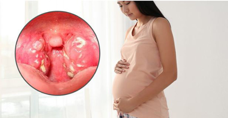 Có nhiều nguyên nhân gây viêm amidan khi mang thai